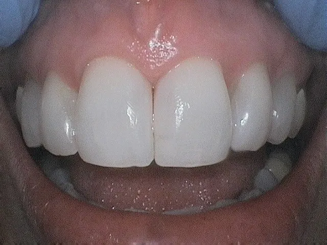 after bioclear